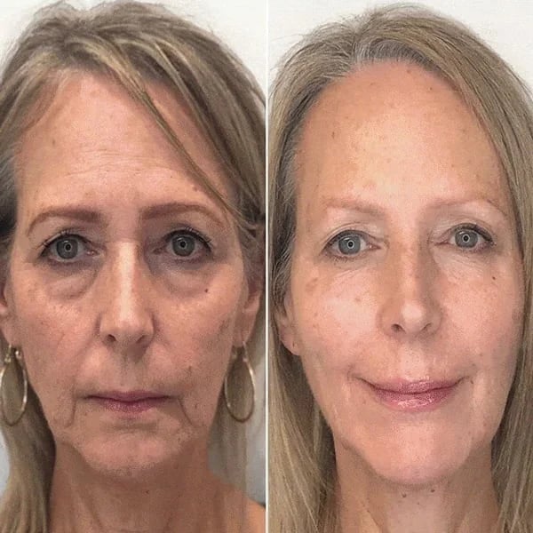 Wrinkle-free skin in just minutes!